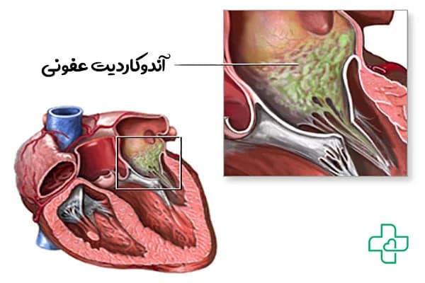 آندوکاردیت قلبی چیست