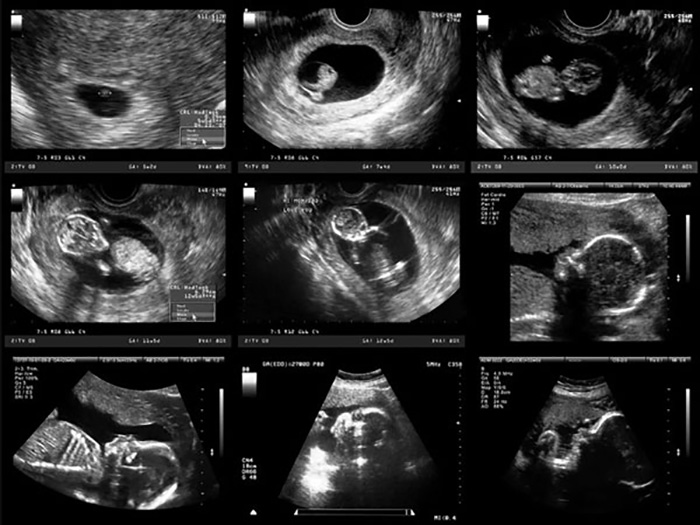 عکس جنین در سونوگرافی ماهانه 