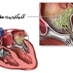 آندوکاردیت قلبی چیست