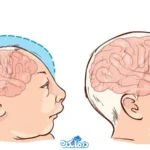 میکروسفالی