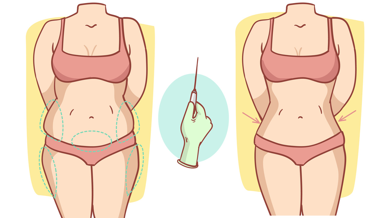 بهترین نواحی بدن برای انجام لیپوماتیک